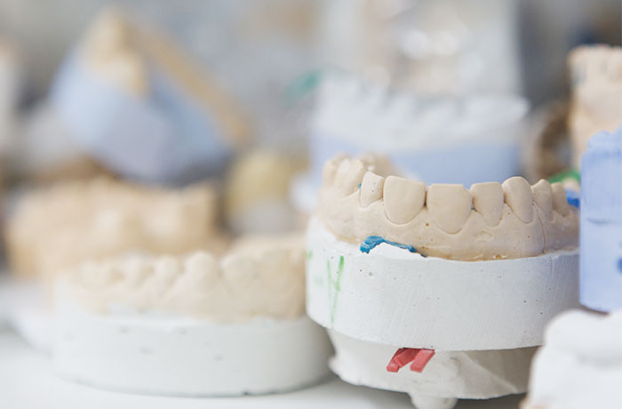 足立区西新井の歯医者ホリ歯科「ナイトガードの作り方と目的」石膏模型の写真