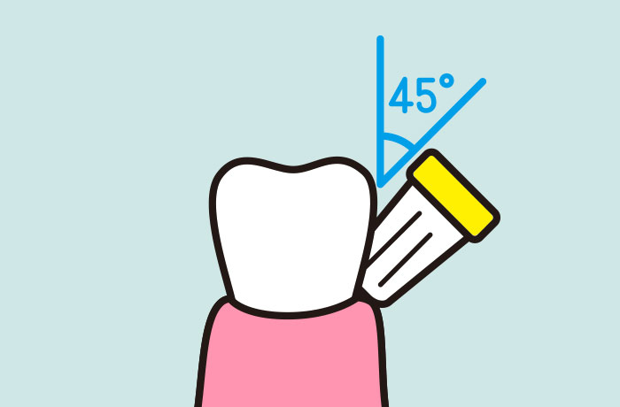 歯の着色汚れの予防